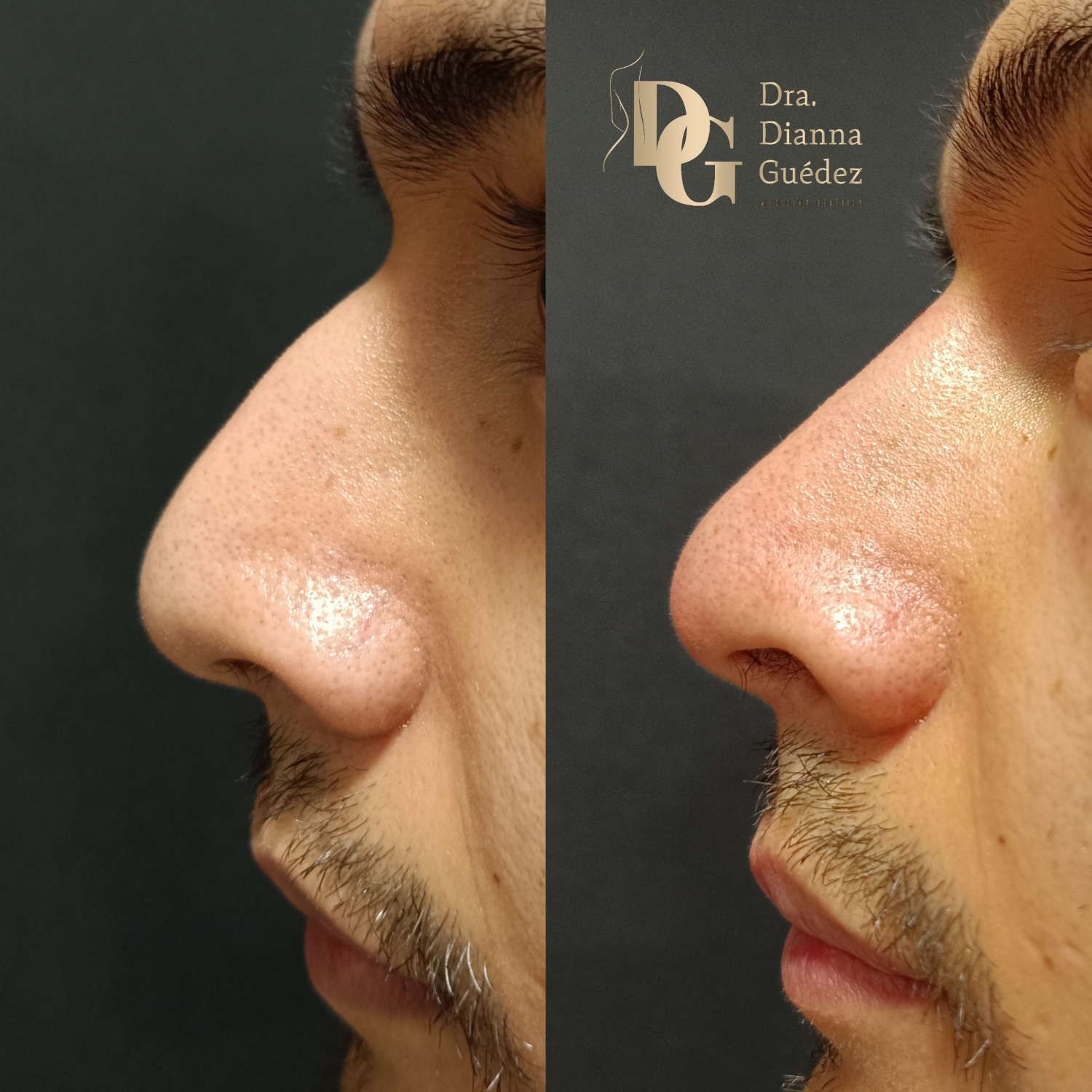 Fotografías de perfil de una nariz antes y después de un procedimiento de medicina estética para alisar el puente nasal.