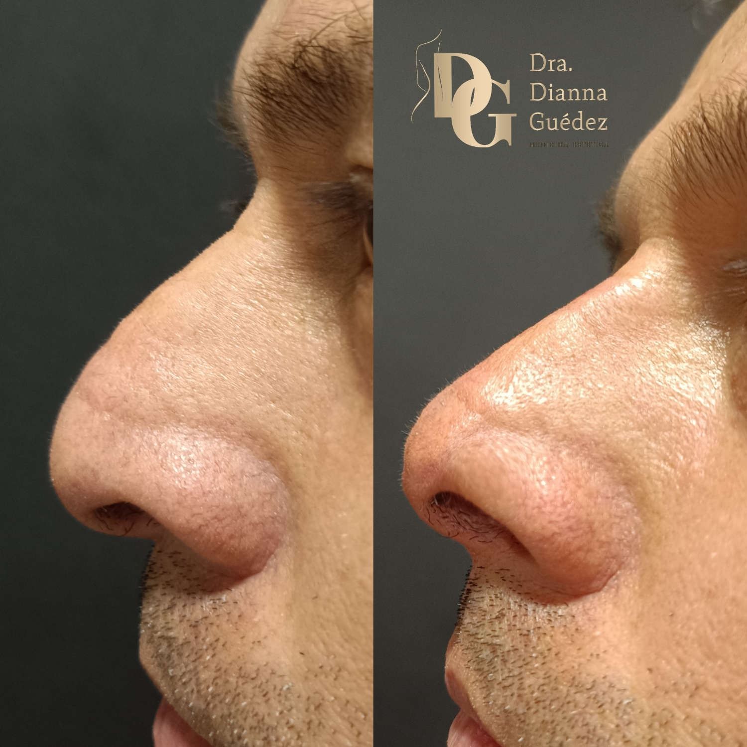 Vistas de perfil de una nariz antes y después de un procedimiento cosmético realizado por la Dra. Dianna Güedez.