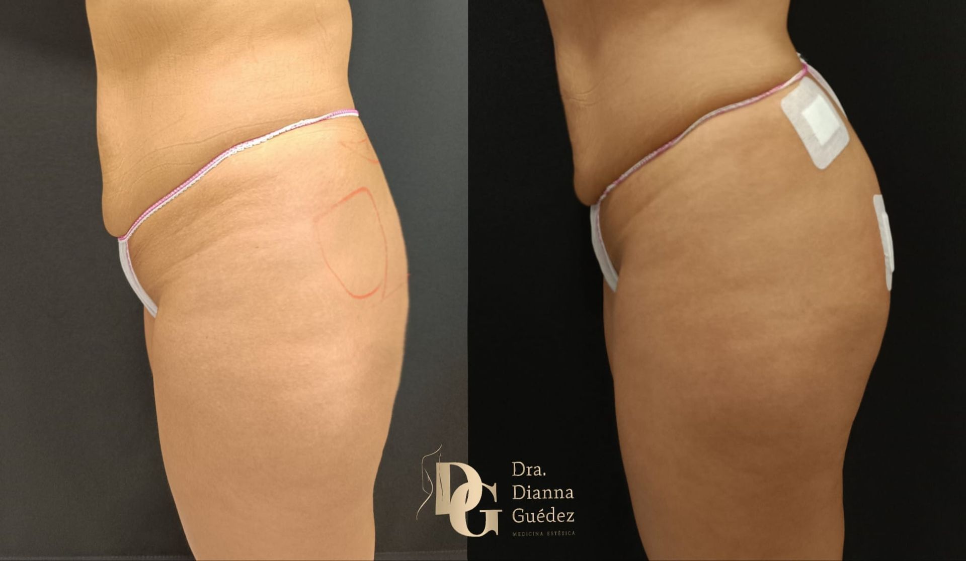 Vista de perfil antes y después de un procedimiento estético que muestra la zona de la cadera y los glúteos de una paciente.