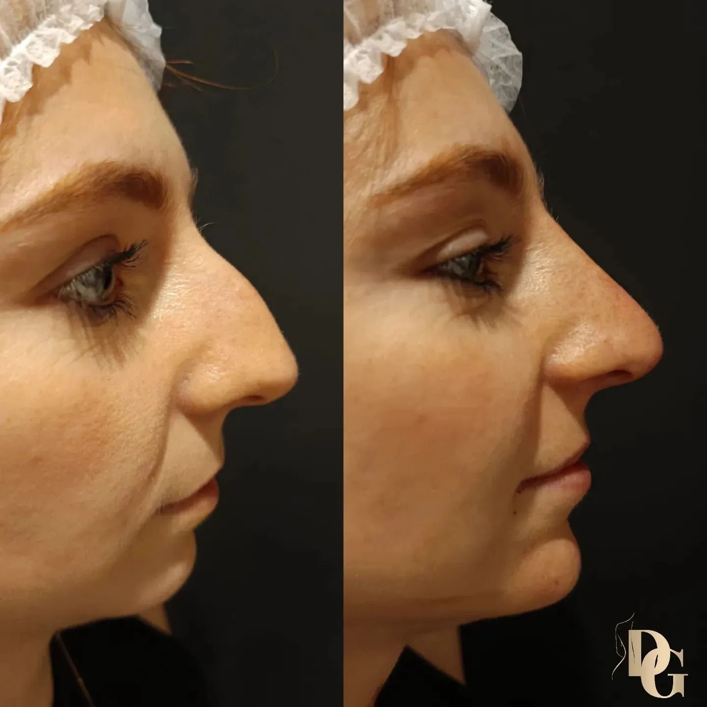 Vista lateral de una nariz antes y después de un procedimiento cosmético, que muestra una reducción de la giba nasal.