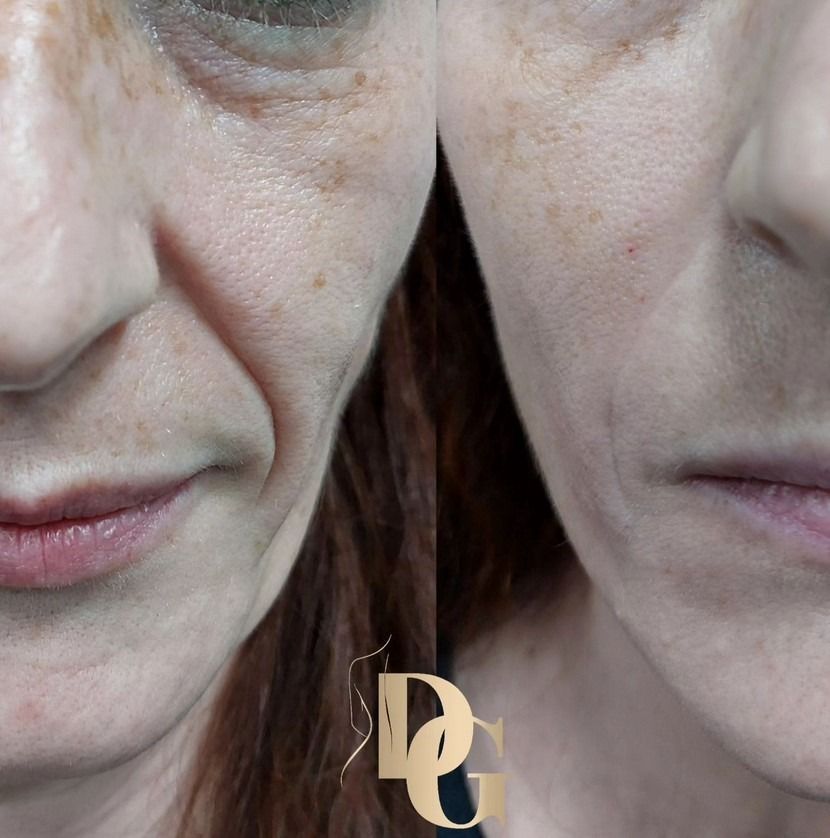 Comparación del antes y el después de un rostro, que muestra una menor visibilidad de los pliegues nasolabiales tras un tratamiento cosmético.