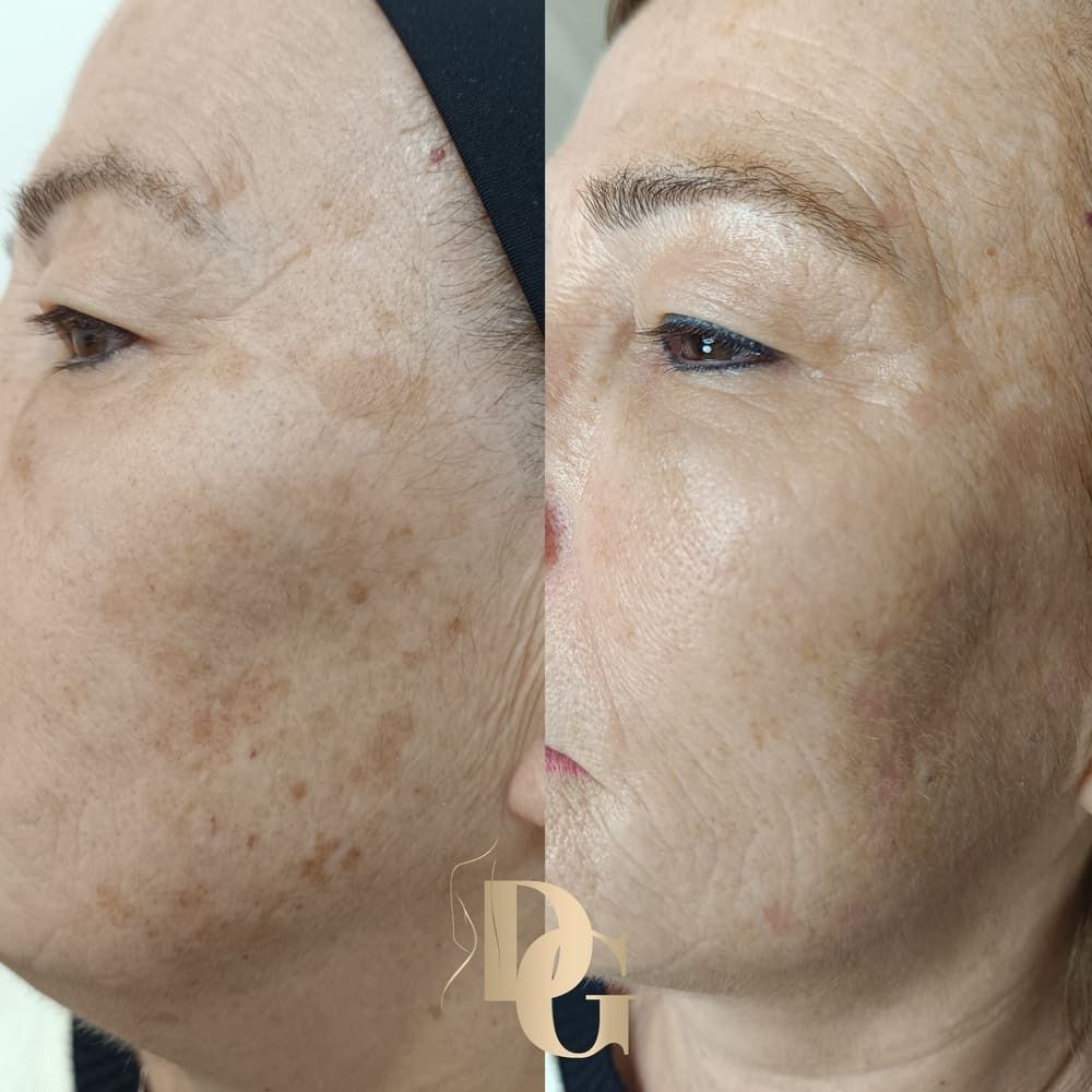 Comparación del antes y el después que muestra una reducción significativa de la pigmentación de la piel y las manchas solares en la mejilla de una persona.