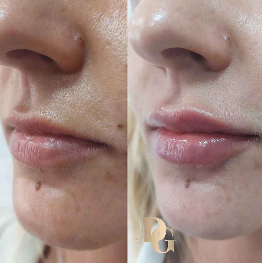 Comparación del antes y el después que muestra los labios de una persona tras recibir un tratamiento con relleno dérmico.