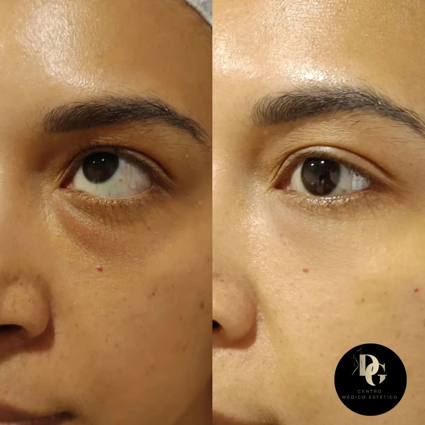 Comparación del antes y el después que muestra la reducción de las ojeras y la mejora de la textura de la piel.