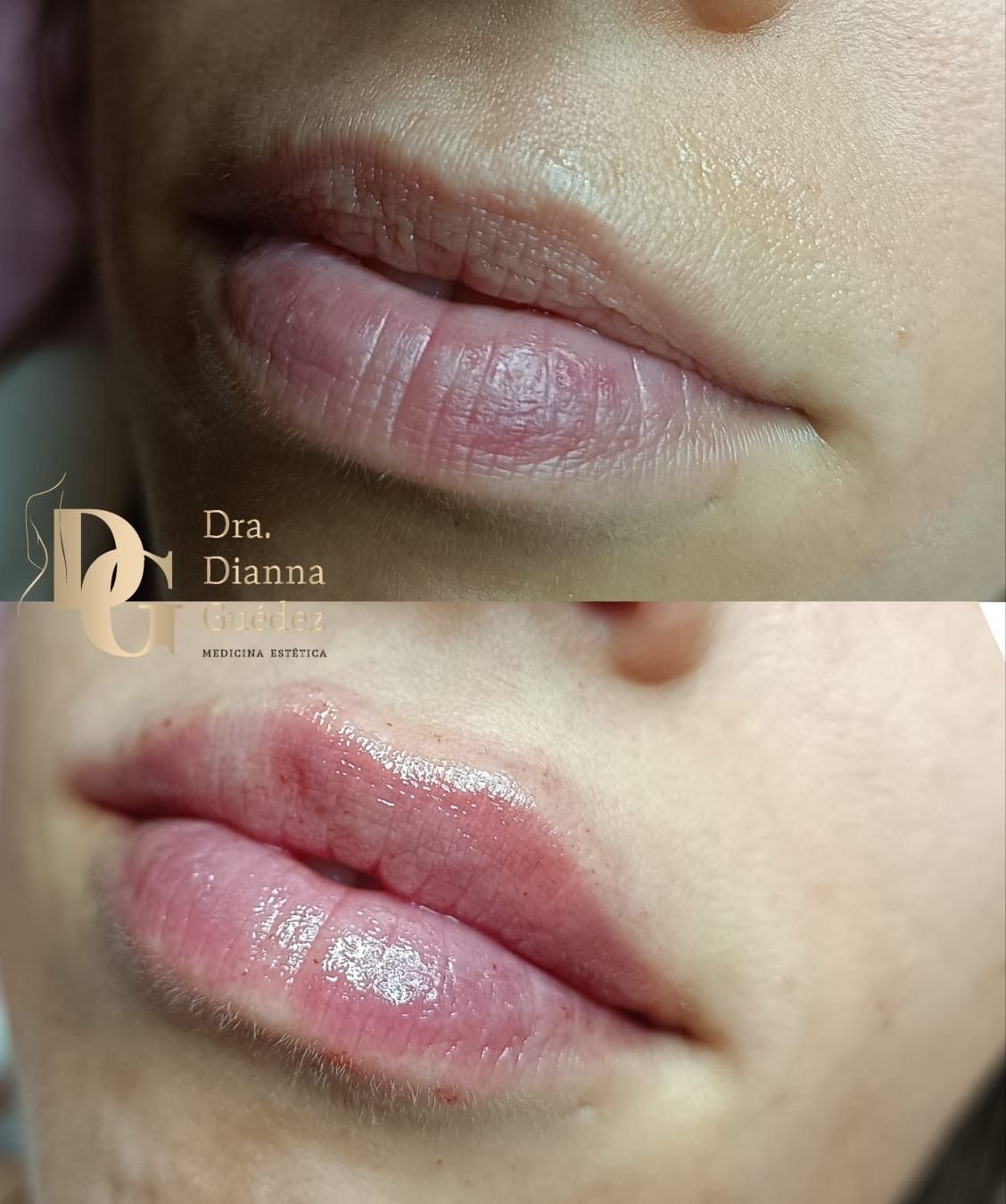 Comparación del antes y el después del tratamiento con relleno de labios, que muestra unos labios más voluminosos, definidos e hidratados.