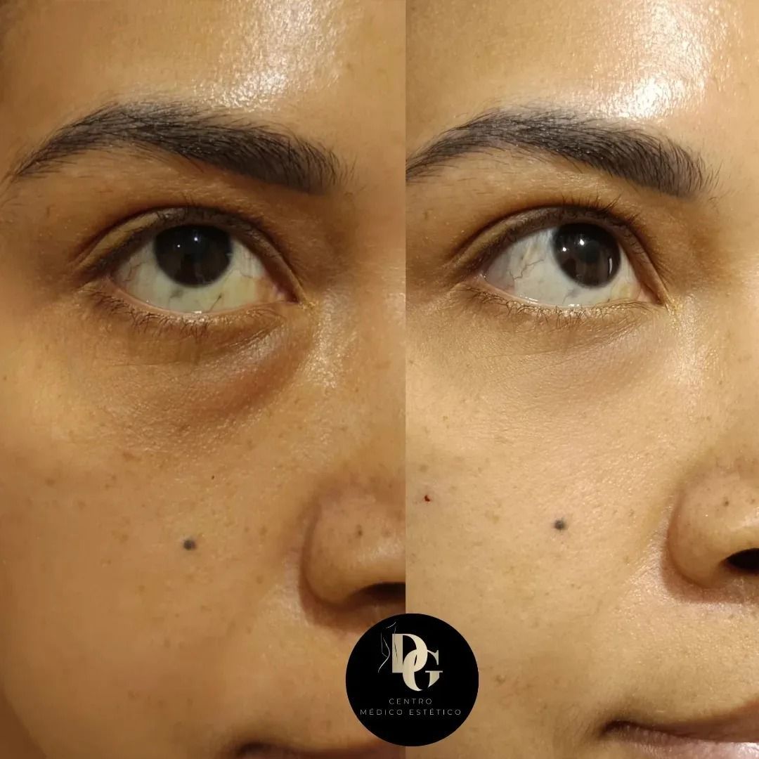 Comparación del antes y el después que muestra la reducción de las ojeras y la hinchazón debajo de los ojos tras un procedimiento cosmético.
