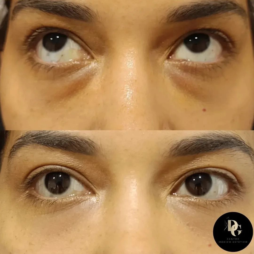 Comparación del antes y el después de ojeras tratadas con relleno dérmico para mejorar el volumen y la apariencia.