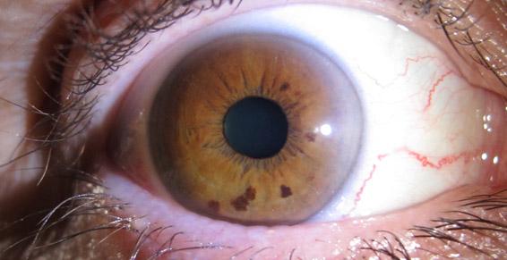 Edwige flament - Naturopathe iridologue - prise de photo pour le bilan iridologique