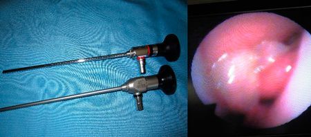 Dos endoscopios médicos sobre una superficie azul y una vista endoscópica del tejido.