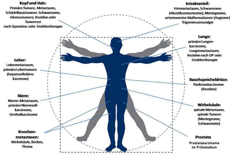 Diagramm eines menschlichen Körpers mit Beschriftungen, die auf mögliche Krebsstellen hinweisen, wie Leber, Gehirn, Lunge.