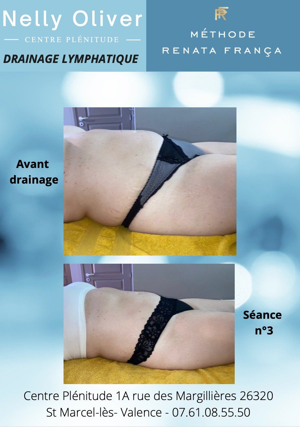 Avant-après ventre profil