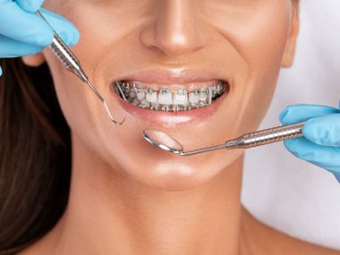 Una mujer con aparatos ortopédicos se hace examinar los dientes por un dentista.