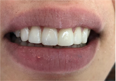 Una mujer sonríe mientras se mira los dientes en un espejo.