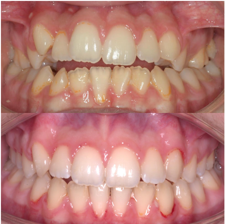 Un primer plano de una mujer con aparatos dentales sonriendo.