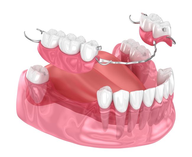 Um close de uma dentadura com uma dentadura parcial em um fundo branco.