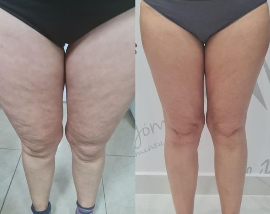 Una foto de antes y después de las piernas de una mujer con la palabra