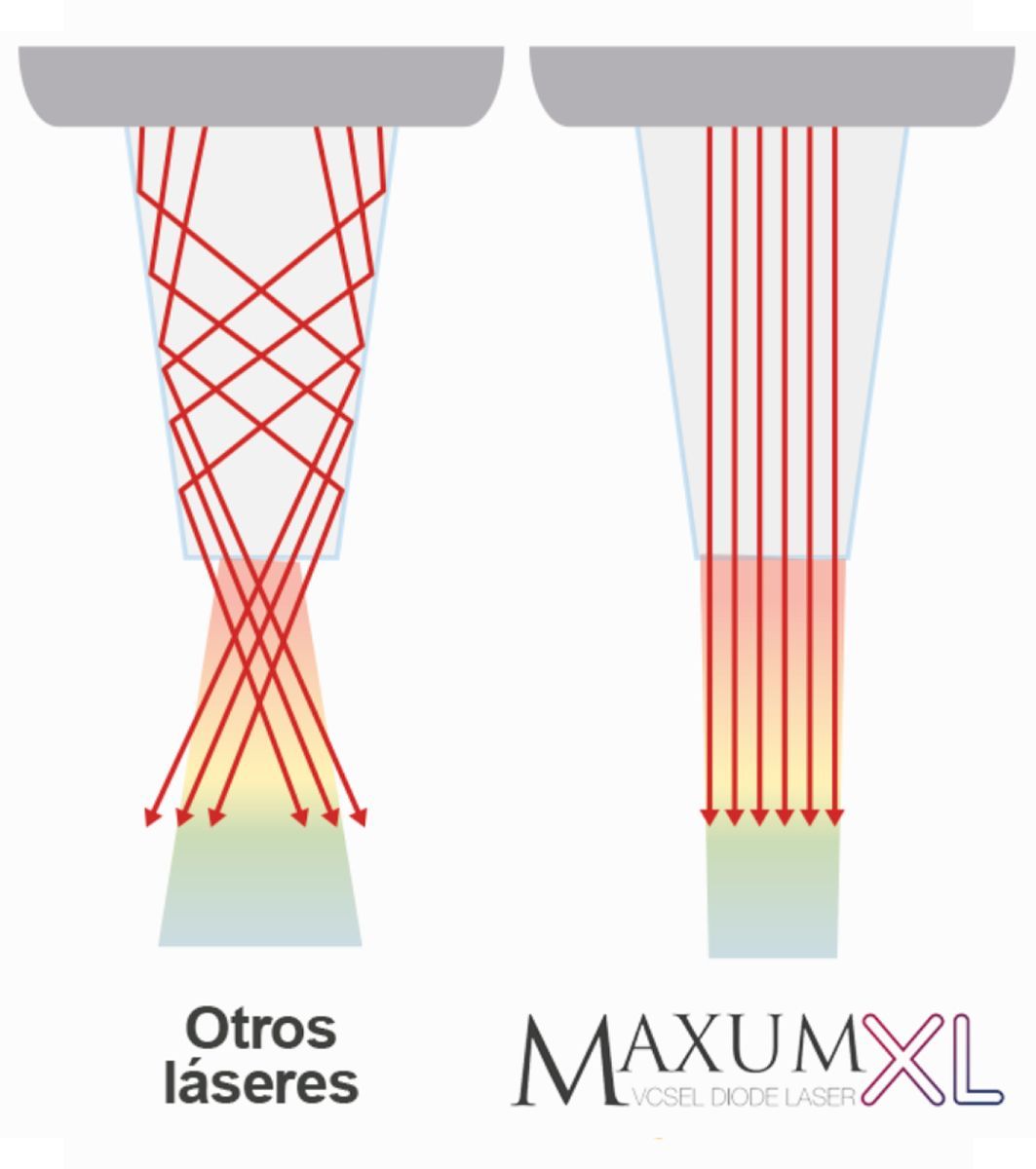 Diagramas comparativos de haces láser, uno al lado del otro, que muestran la luz roja dispersa y la luz roja enfocada, etiquetados como “Otros láseres” y “MAXUM XL”.