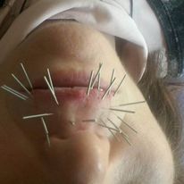 Aesthetic Acupuncture