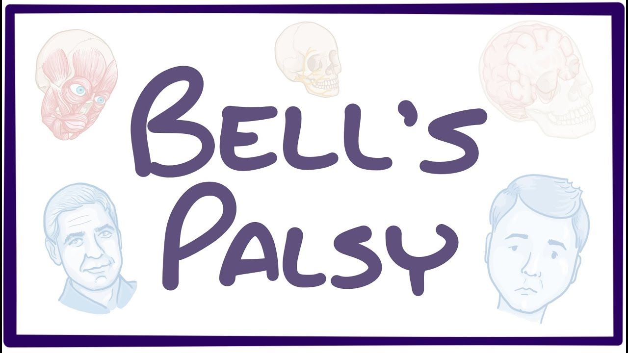 Πάρεση προσωπικού νεύρου (Bell's palsy)