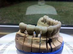 Prothèses sur implants dentaires