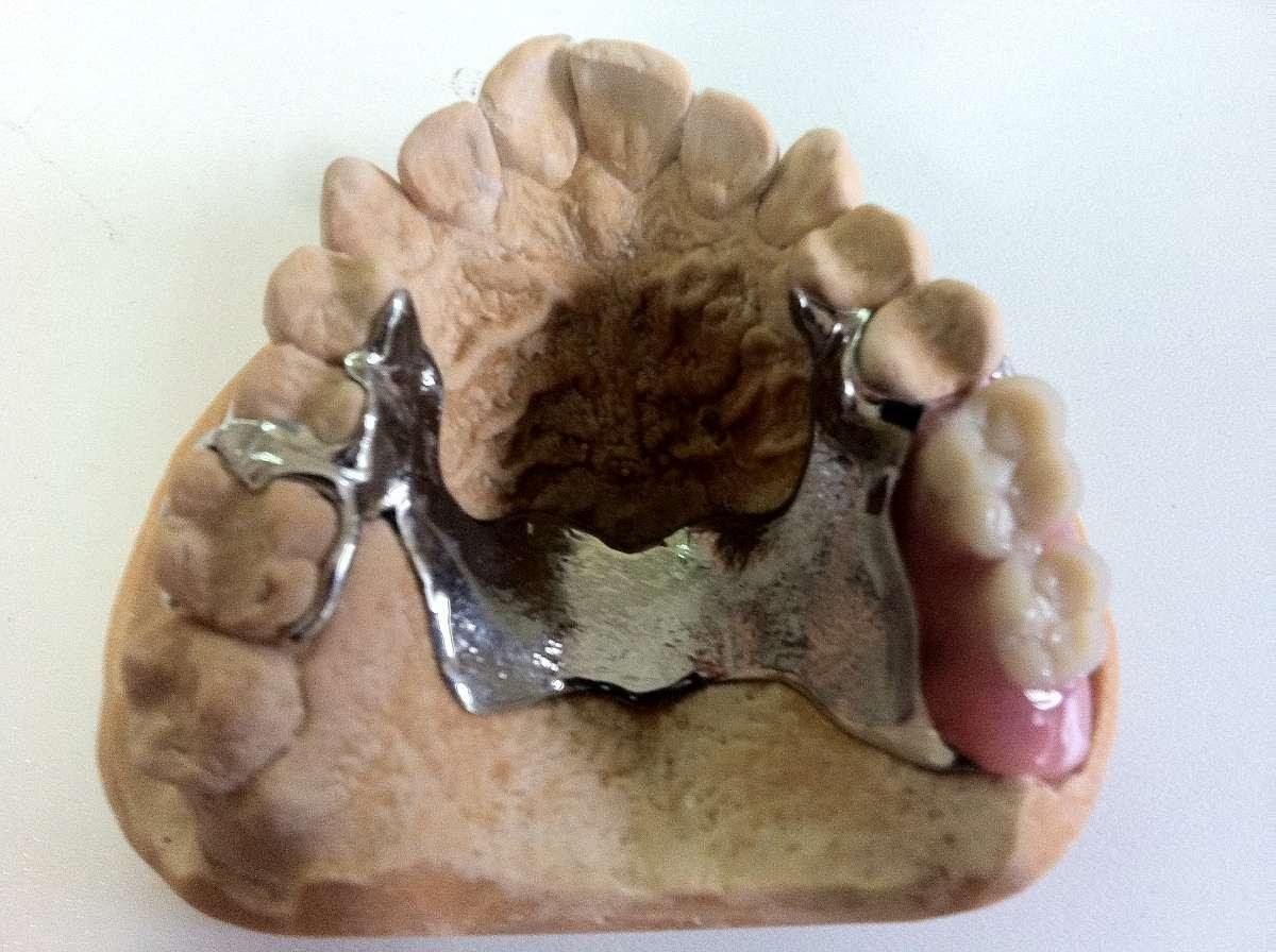 Prothèse dentaire stellite