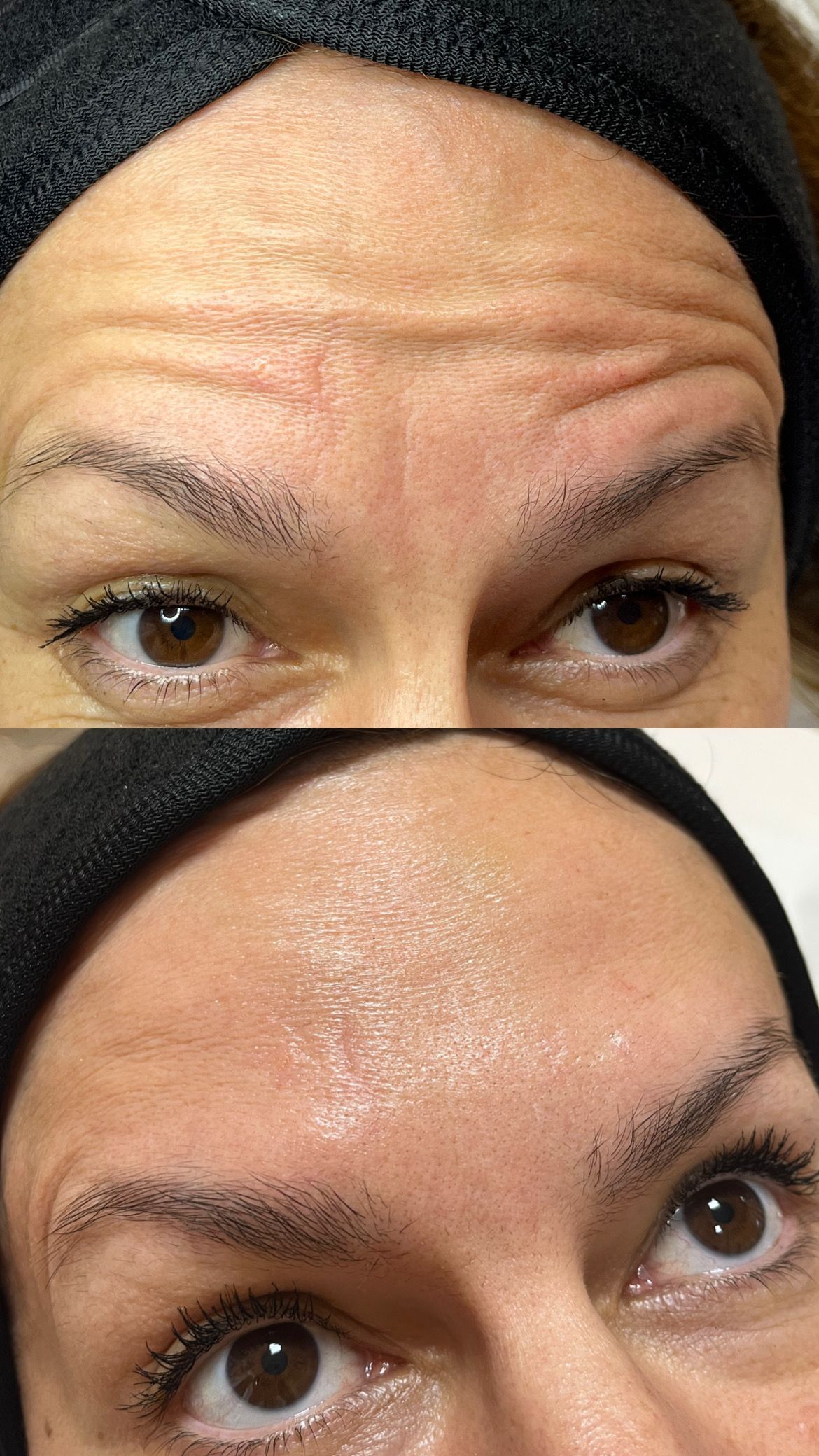 Rugas na testa antes e depois do tratamento, mostrando a pele mais lisa.