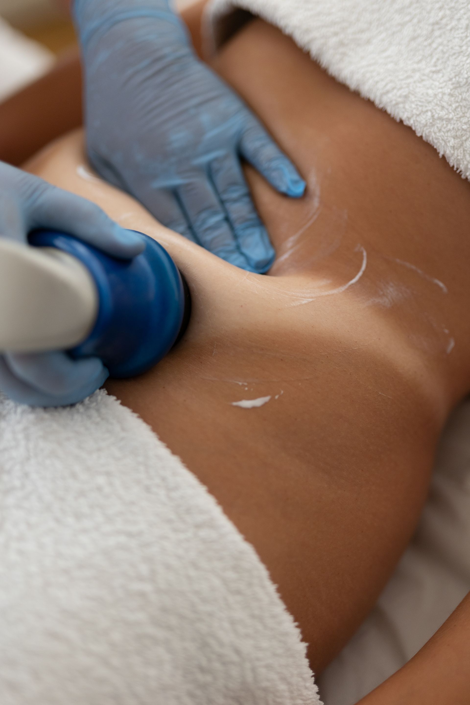 Lipoescultura abdominal antes e depois. 