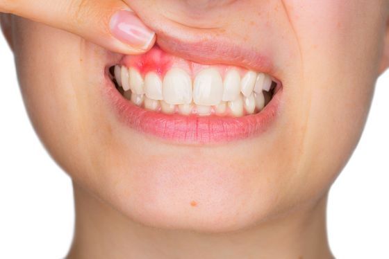Zahnfleischerkrankungen (Parodontitis) - Zahnarztpraxis Dr. Platz AG in Näfels