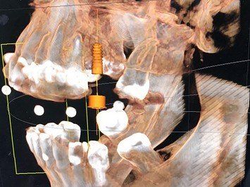 Implantat gesetzt von Rink Berthold Zahnarztpraxis