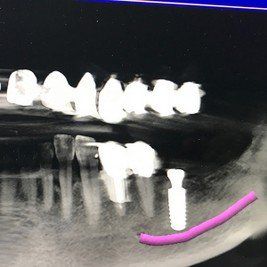 Implantat gesetzt von Rink Berthold Zahnarztpraxis