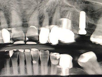 Implantat gesetzt von Rink Berthold Zahnarztpraxis