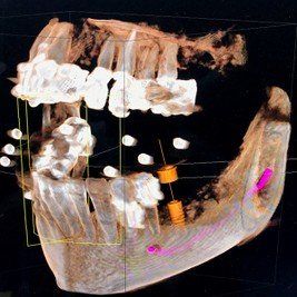 Implantat gesetzt von Rink Berthold Zahnarztpraxis