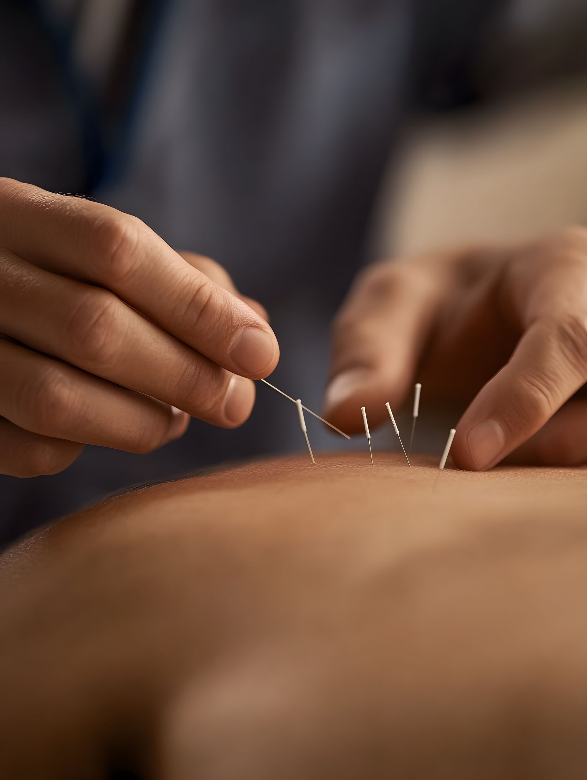 Agopuntaura sulla schiena