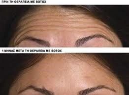 Botox / Dysport
