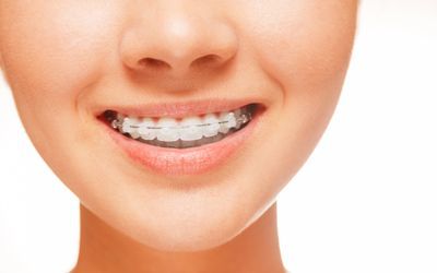 Docteur Tülin Okan - cabinet d'Orthodontie - alignement dentaire