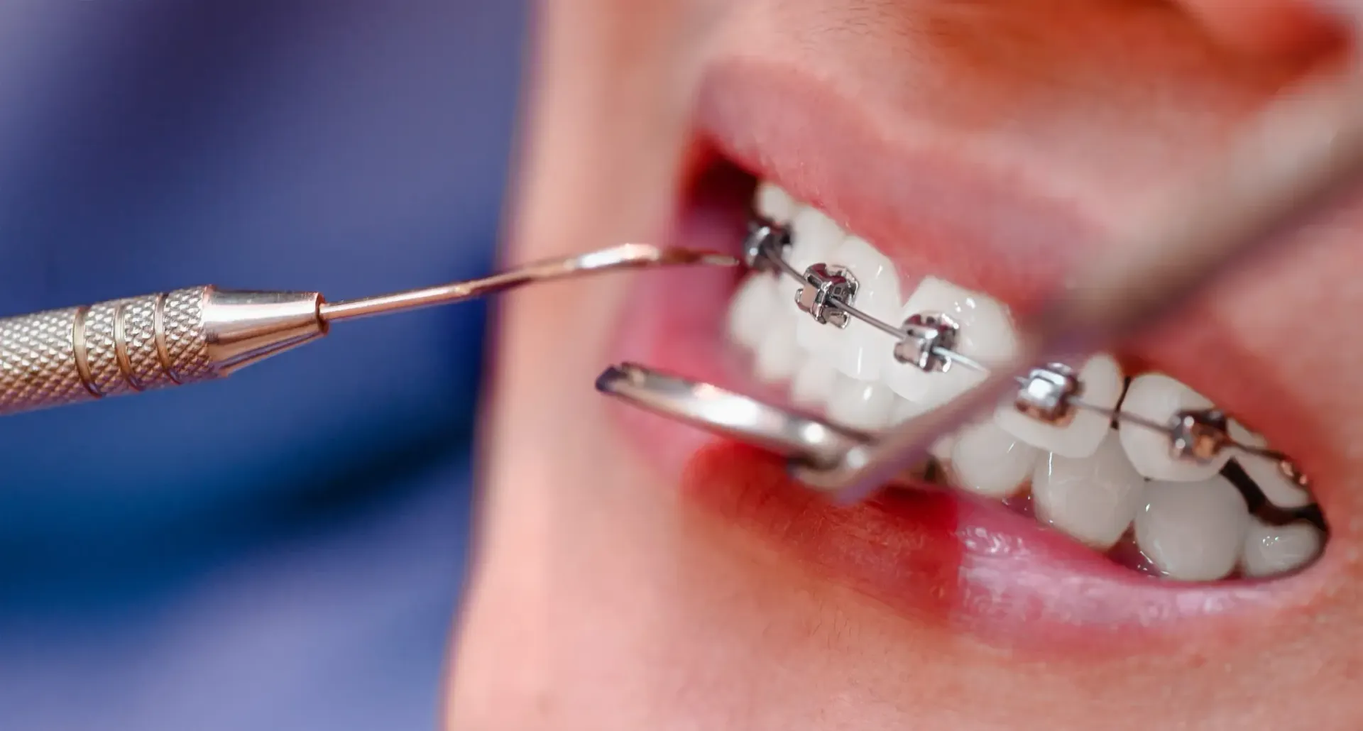 Primer plano de los aparatos de ortodoncia que se ajustan en los dientes de un paciente con una herramienta dental.