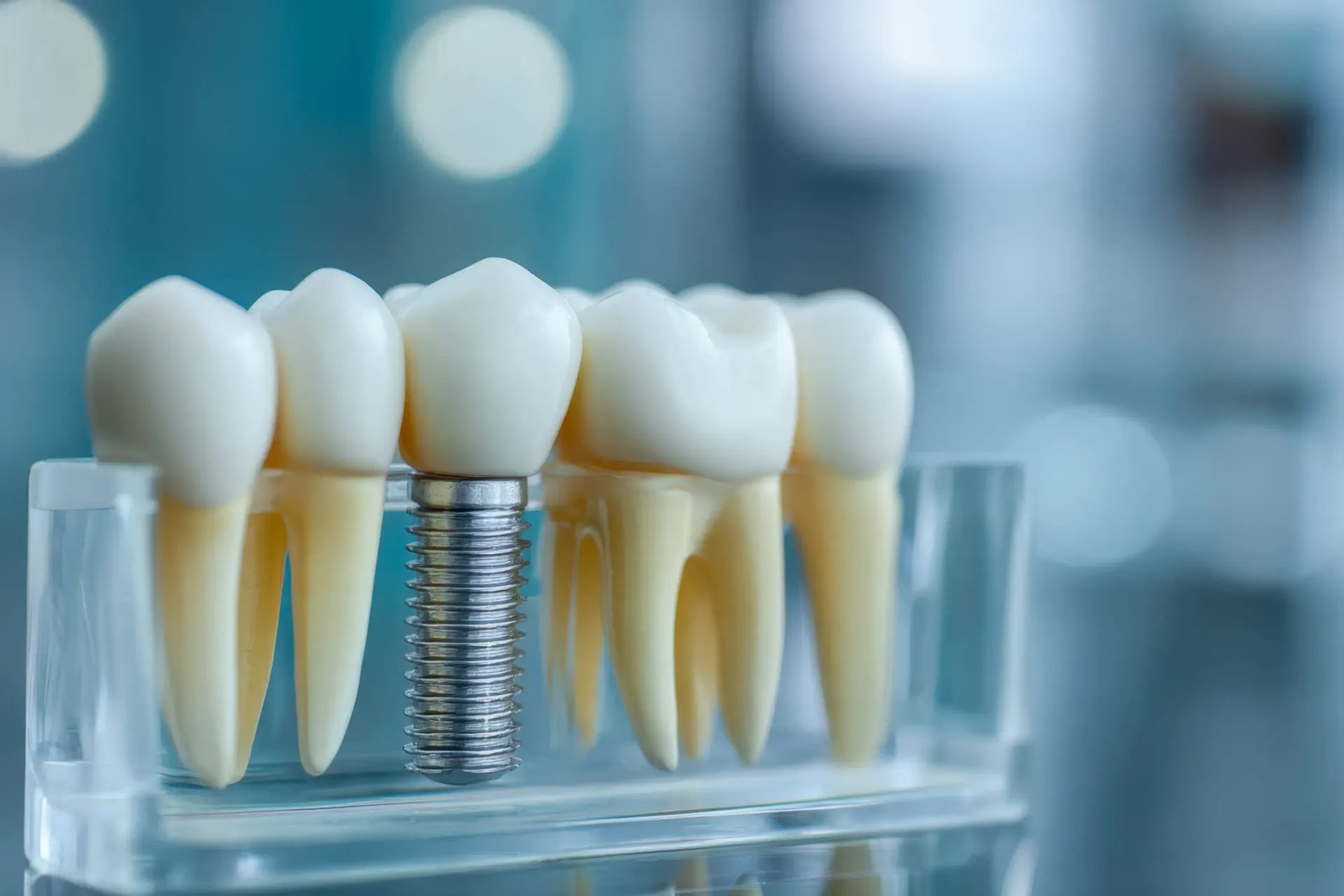 Modelo de implante dental con dientes blancos y tornillo metálico visible sobre un soporte transparente.