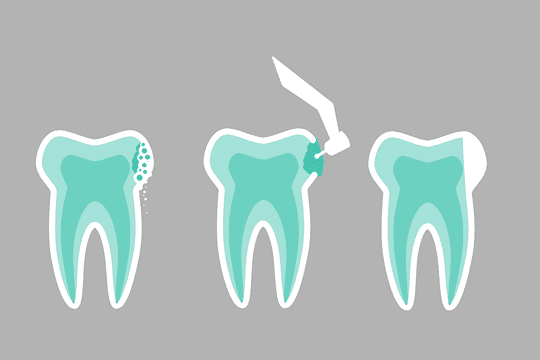 Füllungen Ästhetische Zahnheilkunde