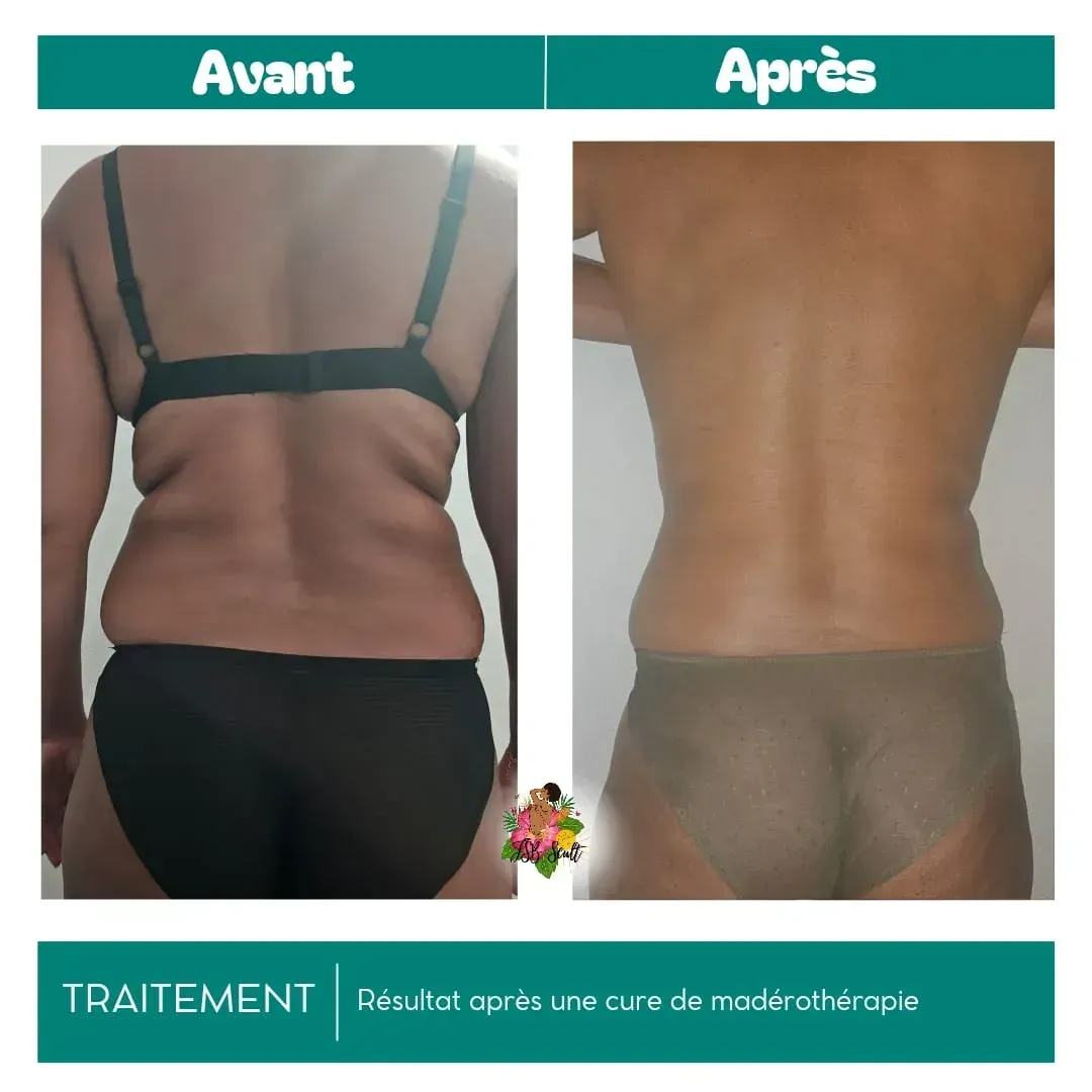 Comparaison avant et après traitement du dos d'une personne ; la photo après montre une peau plus lisse après un traitement de madérothérapie.