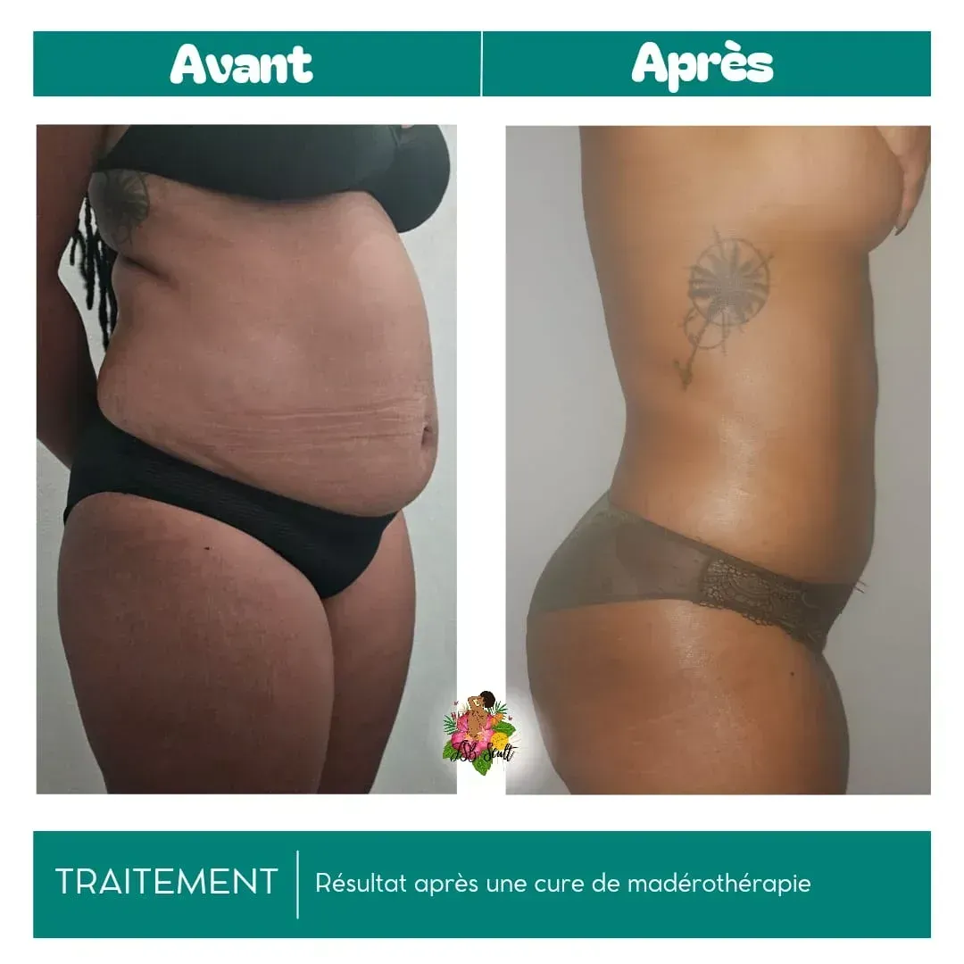 Comparaison côte à côte du corps d'une personne avant et après un traitement de mésothérapie ; montrant une réduction de la graisse abdominale.