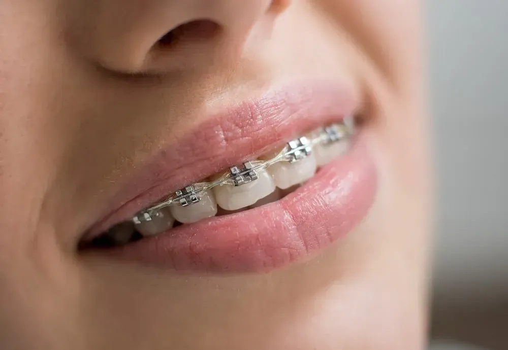 Un primer plano de la boca de una mujer con aparatos dentales.