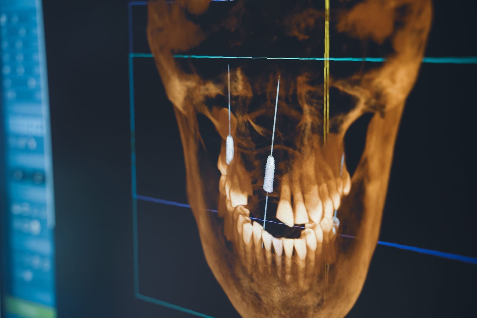 Imagen tipo rayos X de un cráneo humano y dientes con líneas de cuadrícula azules sobre un fondo oscuro.