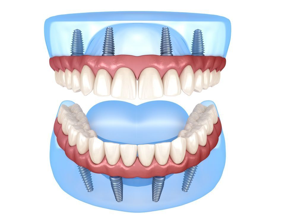 Un modelo de una dentadura postiza con implantes dentales en ella.