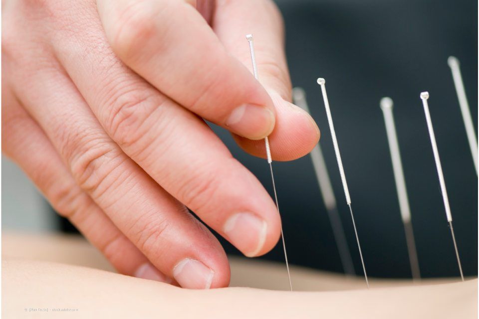 Arzt im Orthopädiezentrum Nürnberg setzt Akupunkturnadeln ein