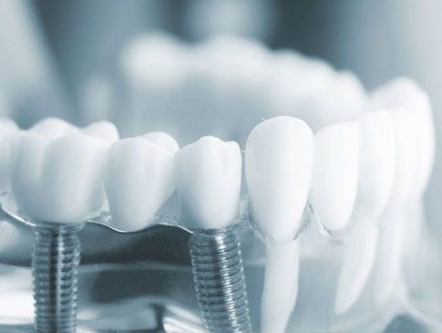 Un primer plano de un modelo de dientes con implantes dentales.