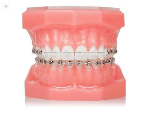 Un modelo de los dientes de una persona con aparatos ortopédicos.