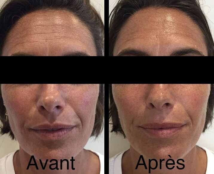 Photo avant/après pour séance Peeling du visage