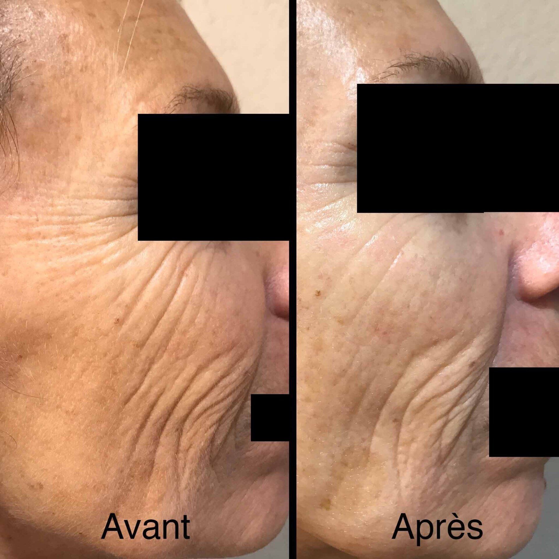 Photo avant/après pour séance antirides du visage