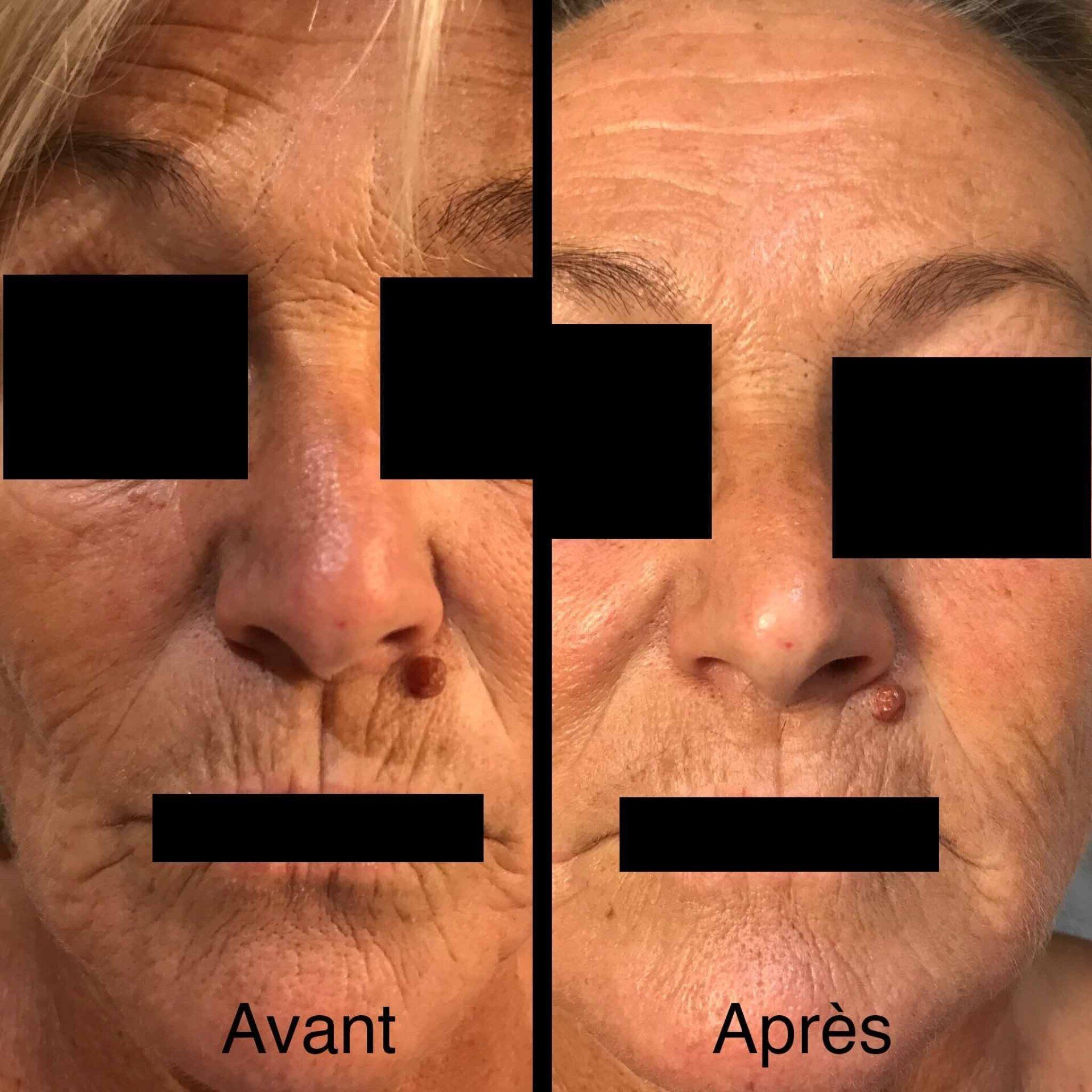 Photo avant/après pour soin complet anti-âge du visage