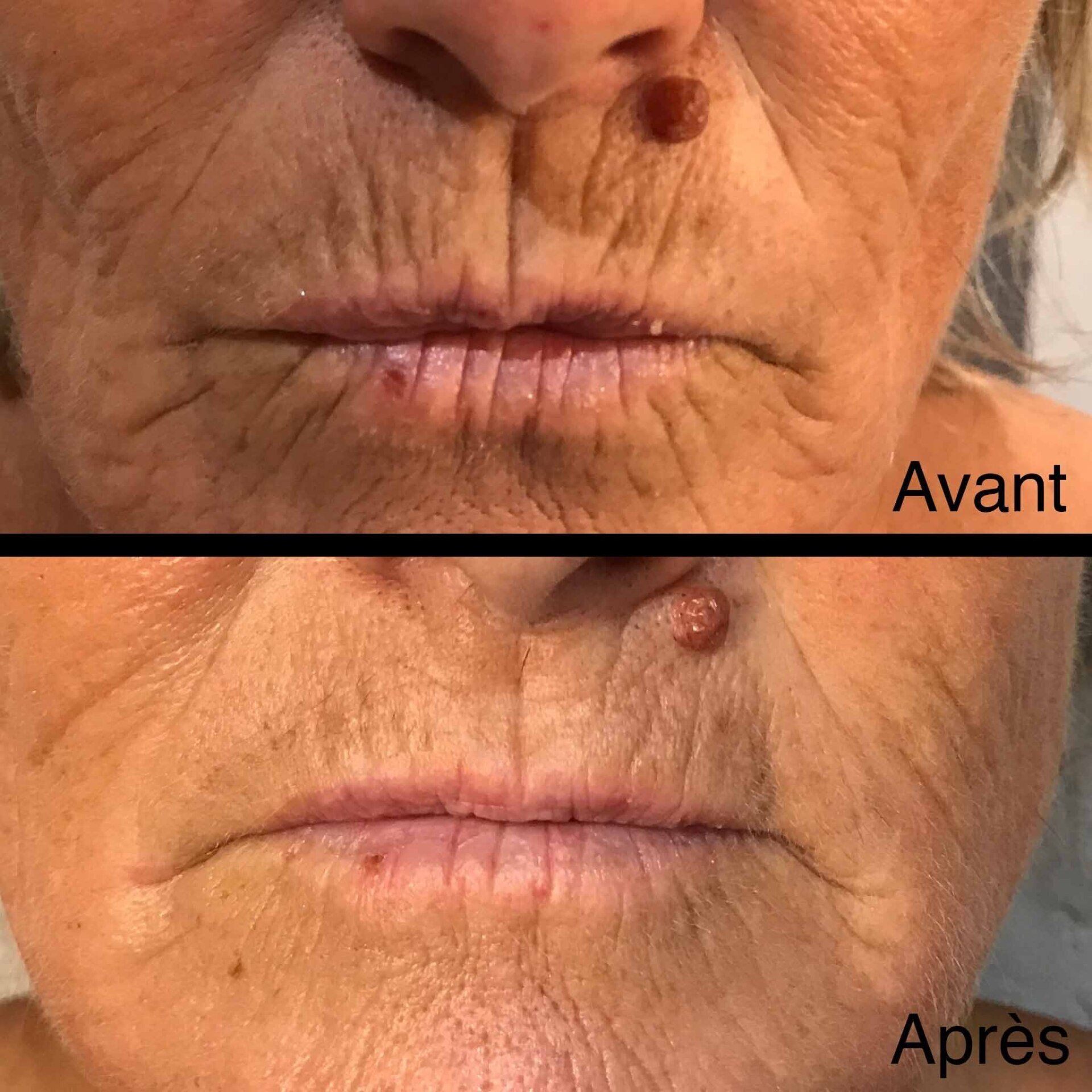 Photo avant/après pour soin antirides de la bouche